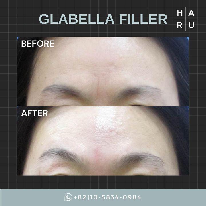 Transform the way you express yourself with our Glabella Filler treatment. Designed to smooth the lines between your brows, this quick procedure helps reflect your inner youth and vitality. See the difference with Haru Clinic - where subtle changes make a significant impact. 🌈