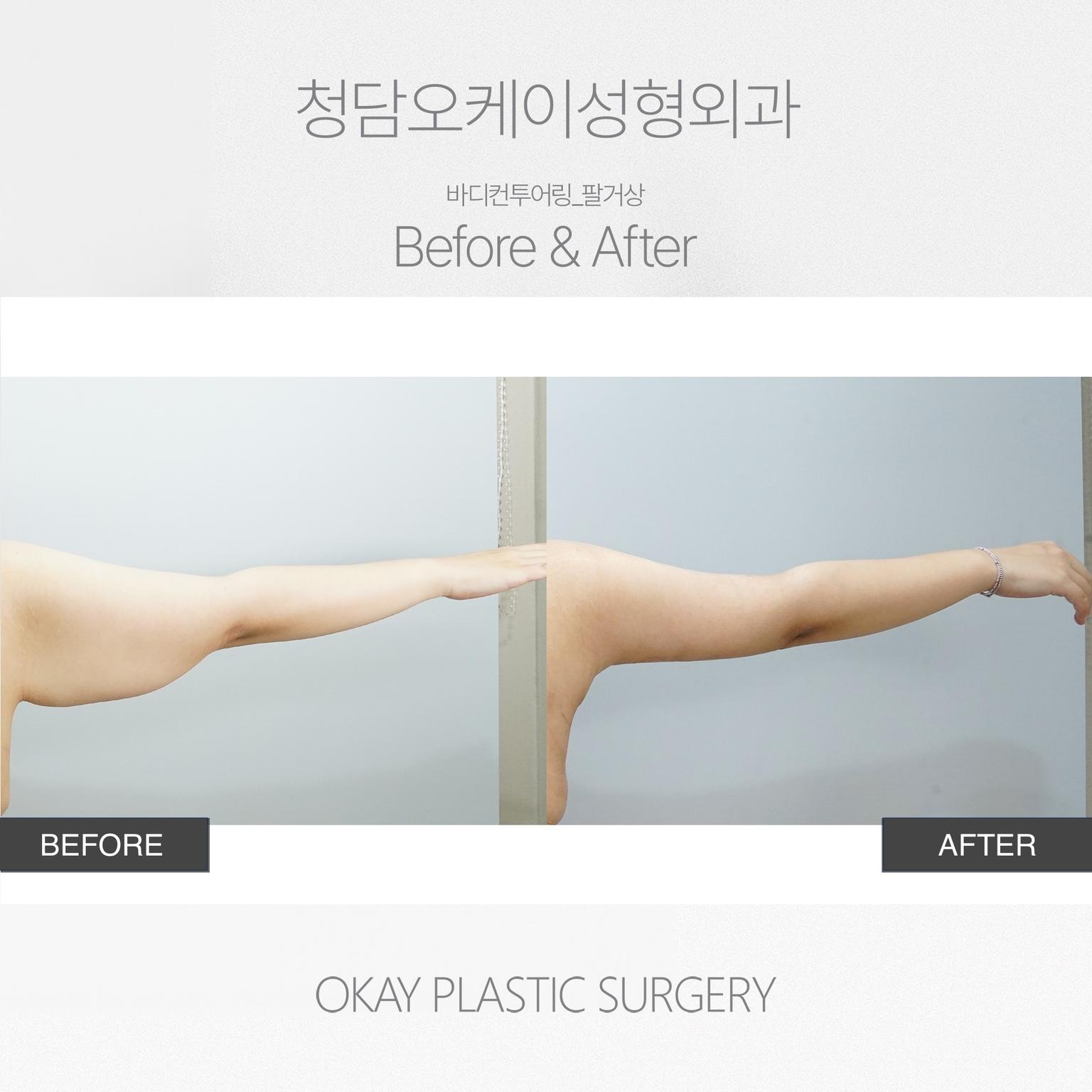 Okay Plastic Surgery Clinic before and after image