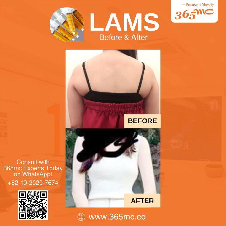 Precision meets comfort in our LAMS procedure. With local anesthetic and minimal invasion, your journey to confidence is smoother than ever.