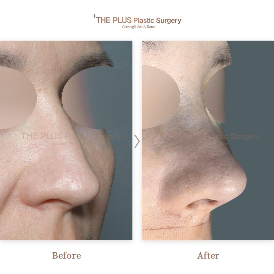 2nd Revision Rhinoplasty & Nose Osteotomy & Septoplasty & Rhinitis Surgery