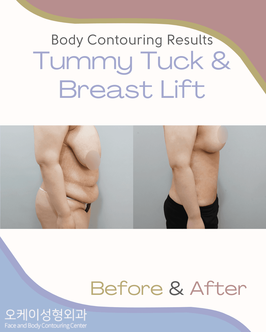 Breast Lift, Breast Reduction, Tummy Tuck