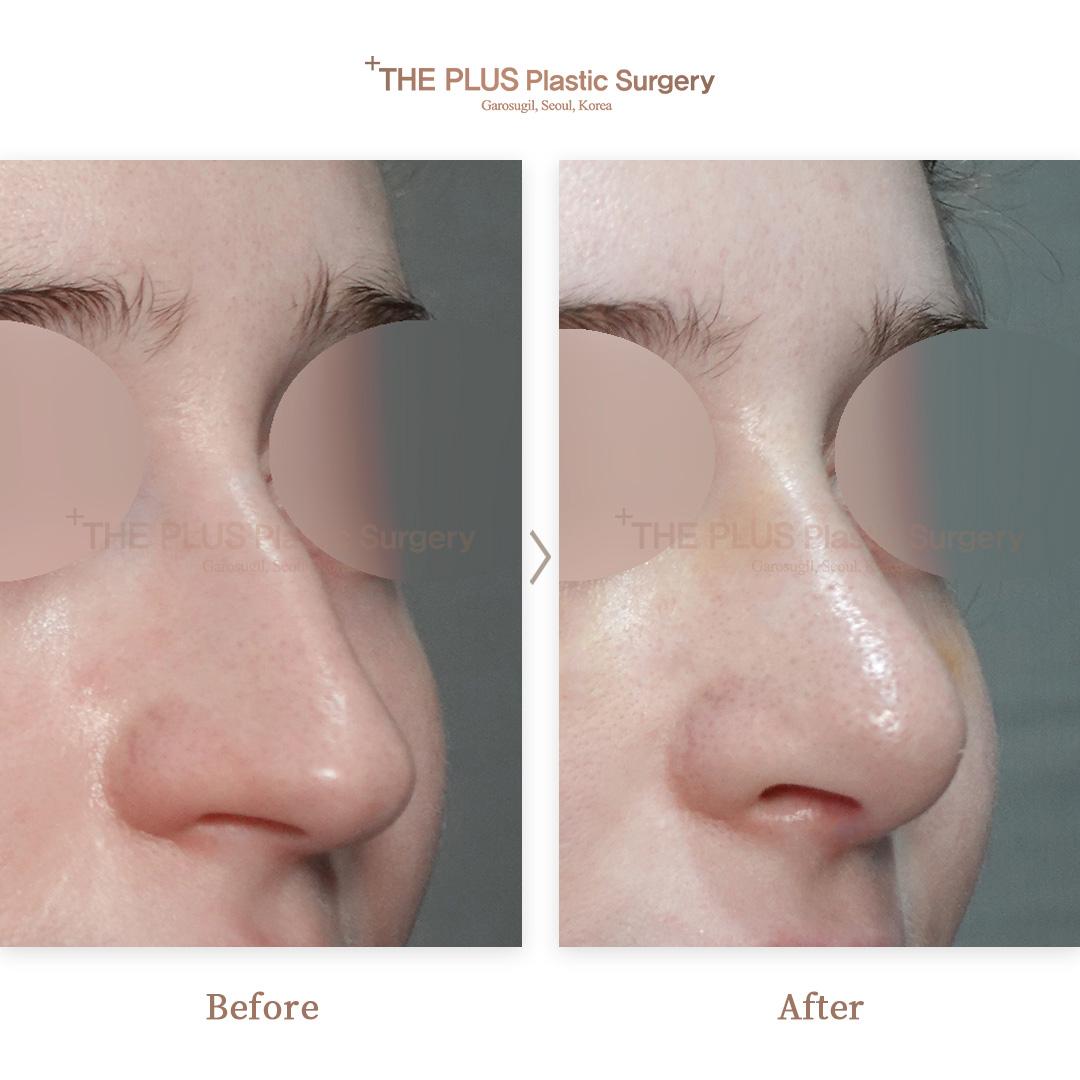 Hump Nose Correction & Septal Cartilage & Nasal Septum Deviation & Rhinitis Surgery