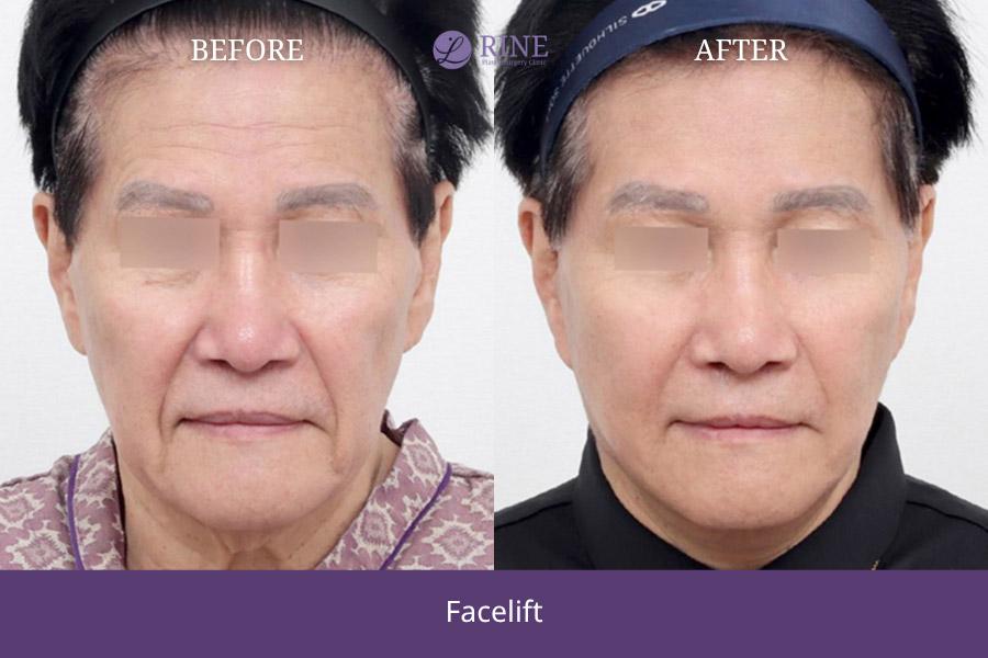 SMAS Facelift