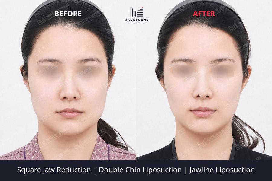 Jaw reduction double chin liposuction jawline liposuction 1