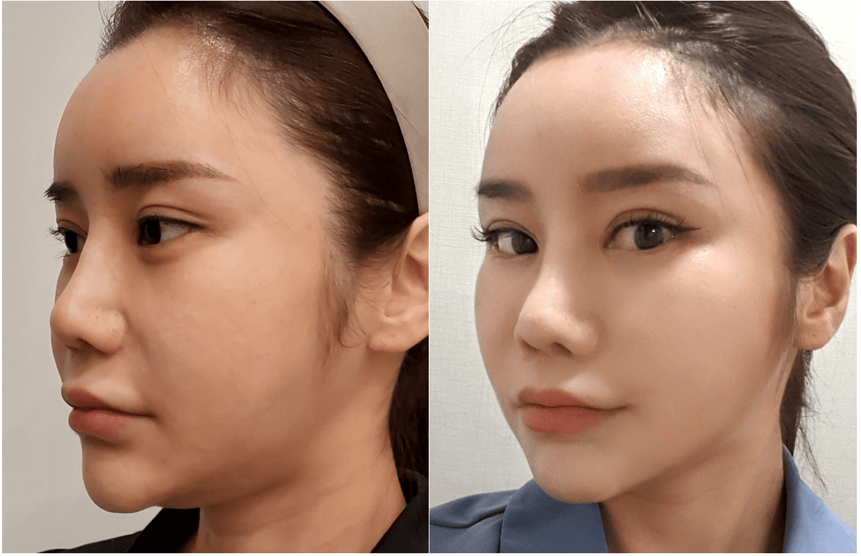 thread lift korea before after