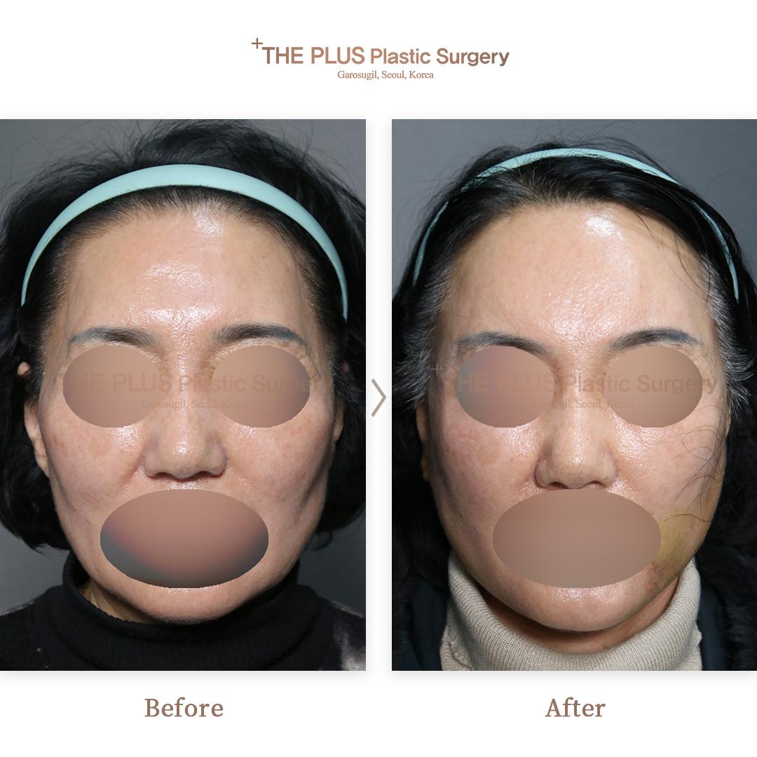 Face contouring + Mini Face Lifting + Forehead Lifting + Thread Lifting + Double Chin Tightening