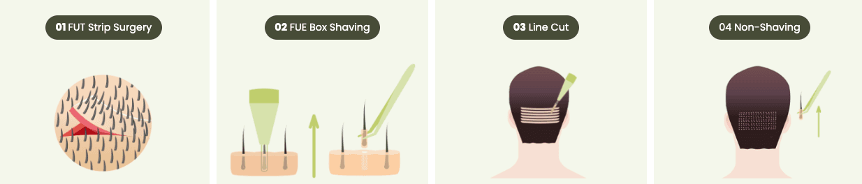 Hair Transplant, Hairline Correction, Hair transplant on Scar