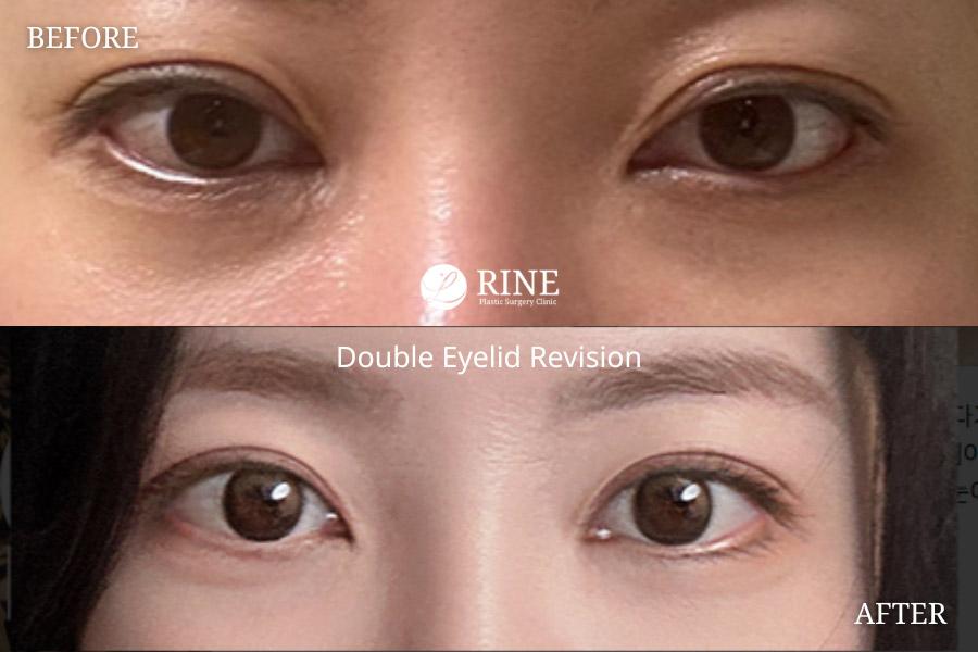 Double Eyelid revision
