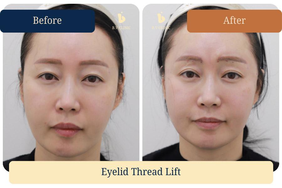 Eyelid Thread Lifting. Before and after photos taken on the day of the procedure.
