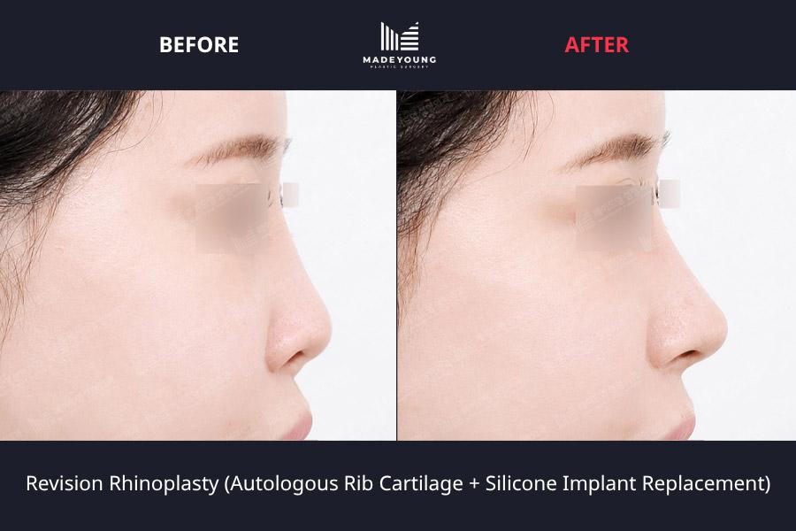 Rhinoplasty autologous rib cartilage silicone implant replacement
