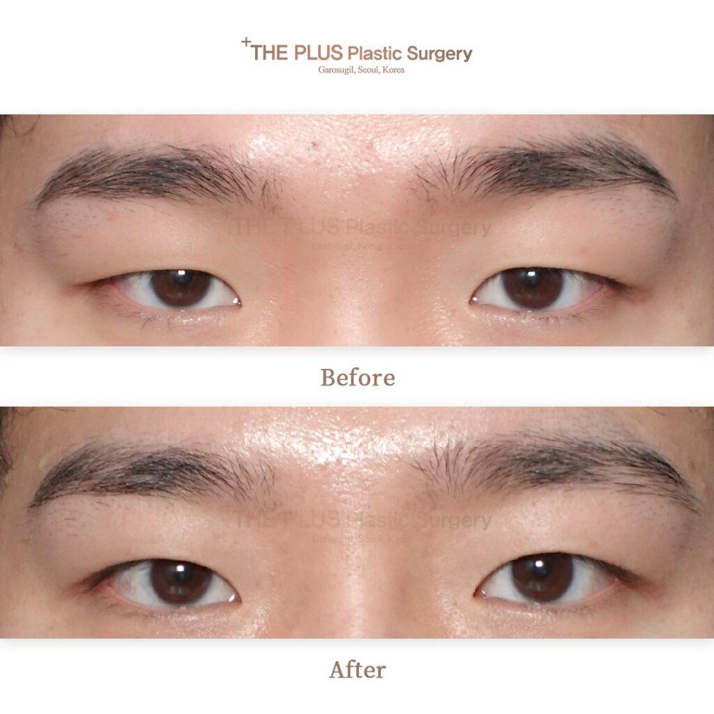 Ptosis Correction