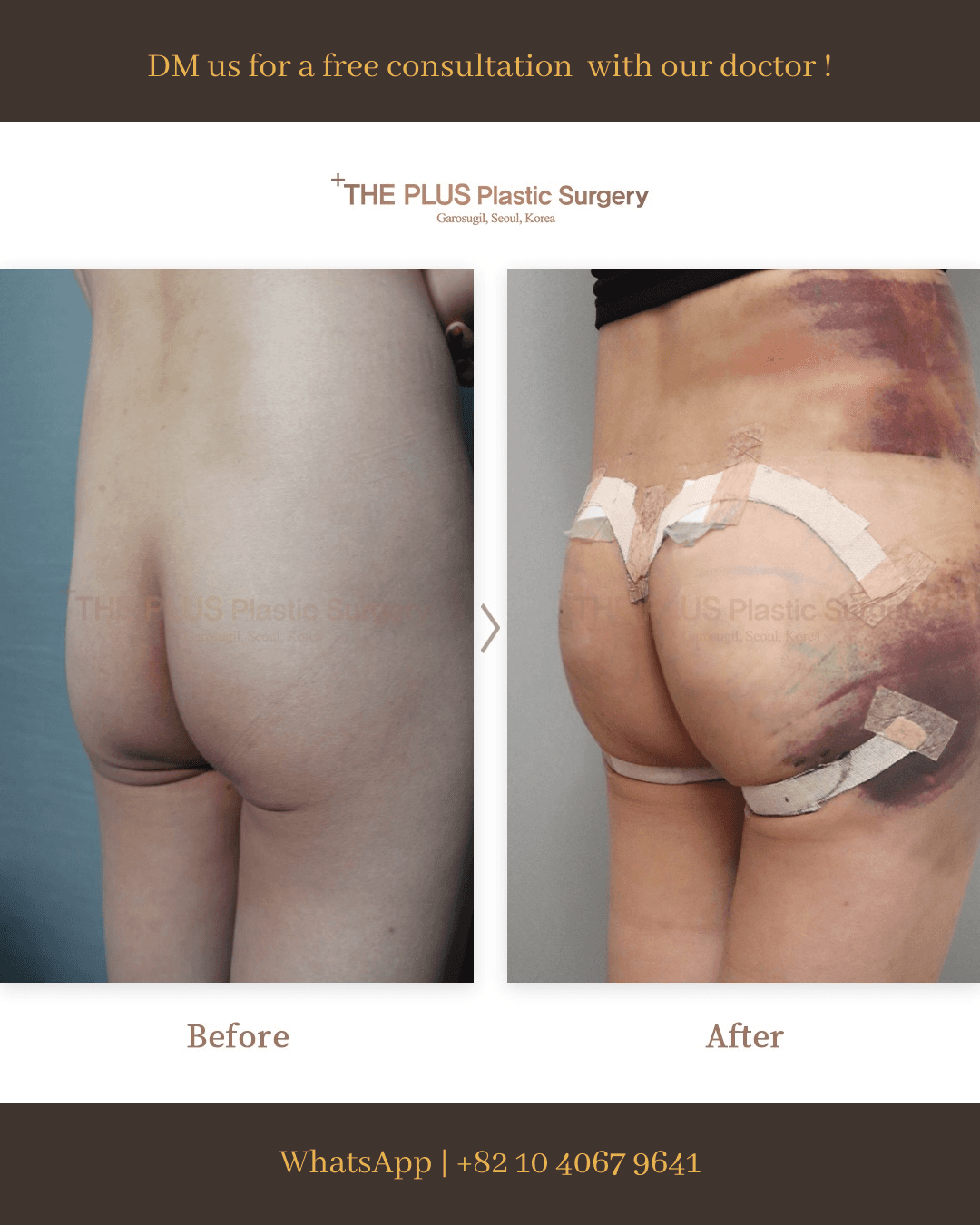 Butt Thread Lift, Brazilian Butt Lift