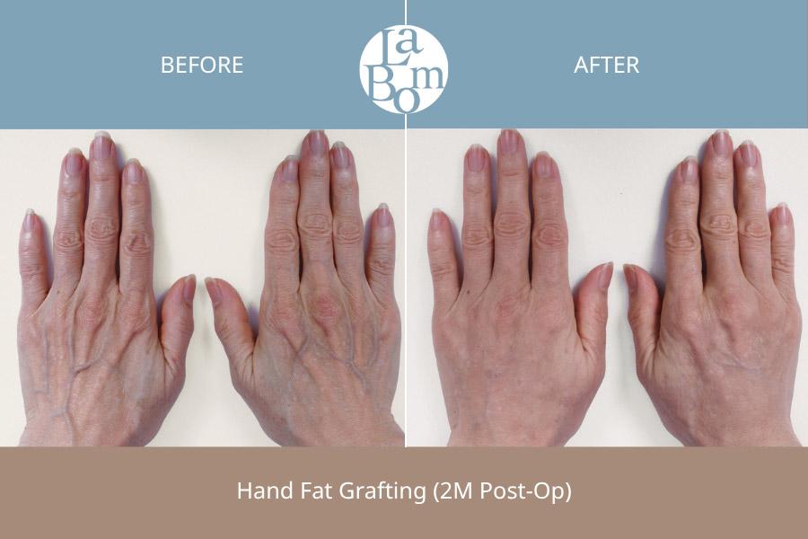 LABOM Plastic Surgery before and after image