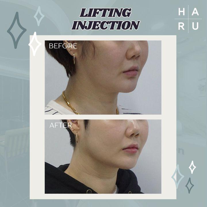 Erleben Sie die Veränderung: Vorher & Nachher einer Lifting-Injektion bei Haru! 🌟 Sehen Sie, wie wir Kieferlinien definieren und Gesichtskonturen wiederherstellen. Bereit für eine subtile, aber wirkungsvolle Veränderung? Entdecken wir Ihre natürliche Schönheit! 🌈