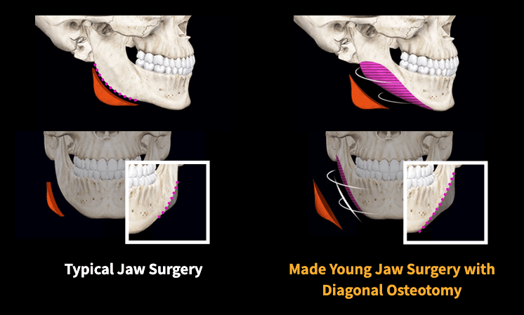 Square Jaw Surgery