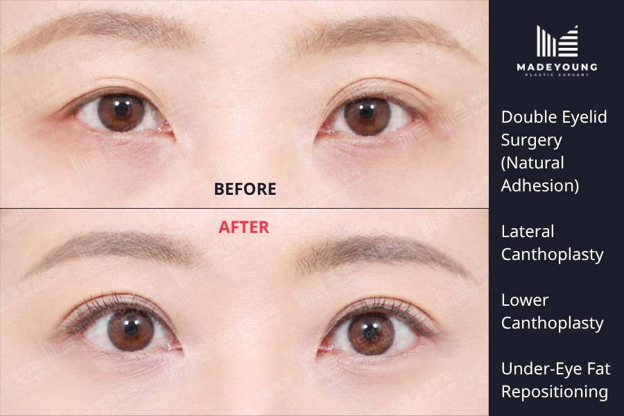 Eyelid surgery natural adhesion lateral canthoplasty lower canthoplasty under eye fat repositioning