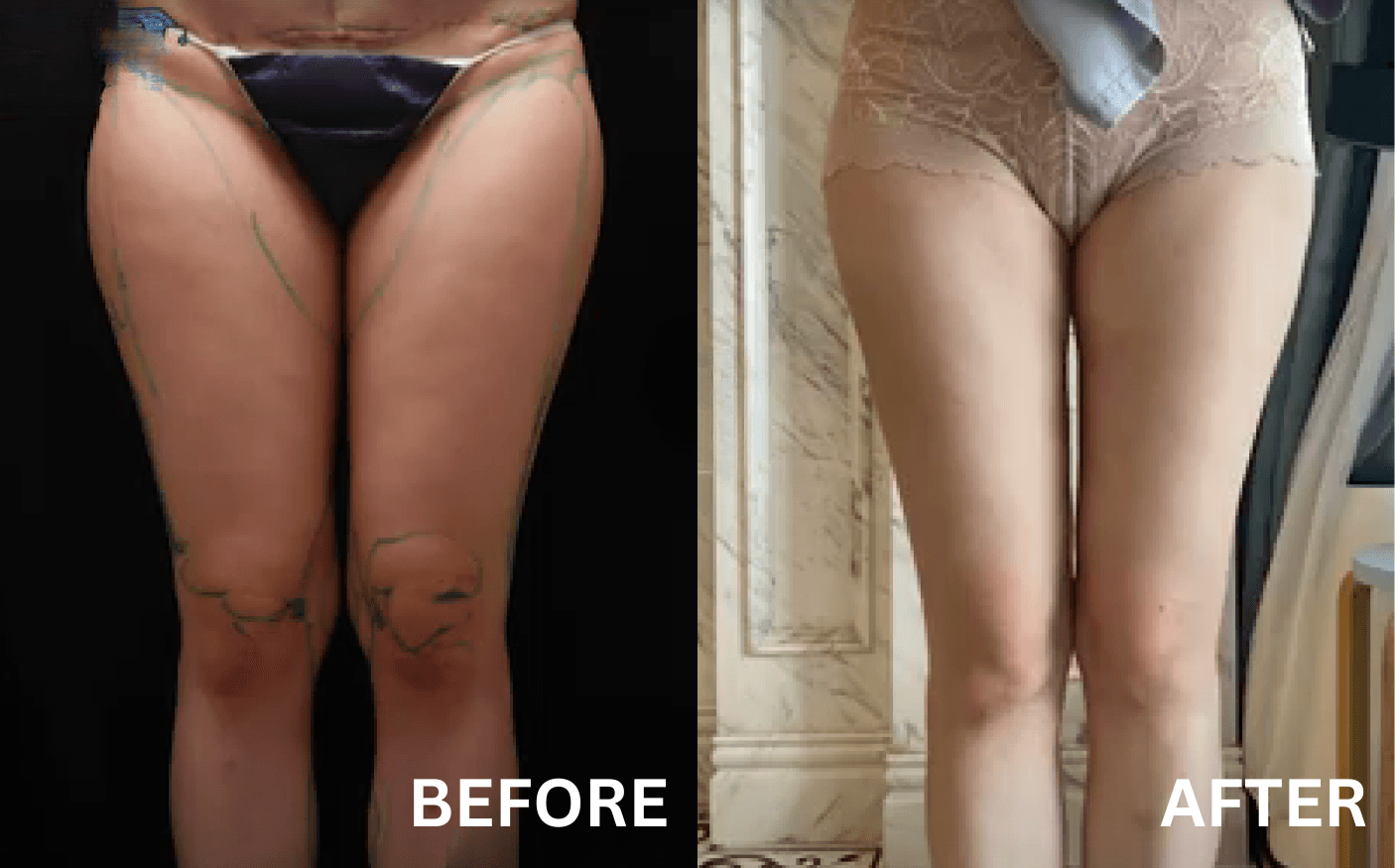 lydian-female-thai-liposuction-01.png