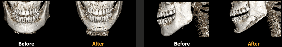 Chin Surgery