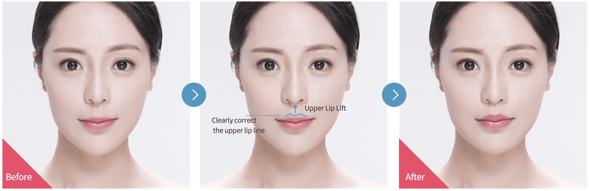 Philtrum Reduction Surgery