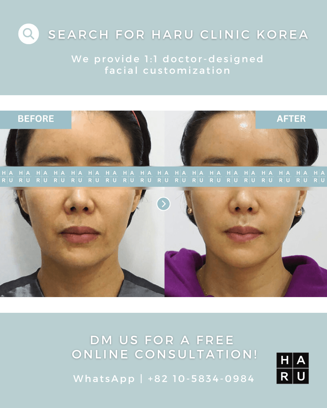 Lippenfiller, Mundwinkel-Lift mit Botox, Fadenlifting