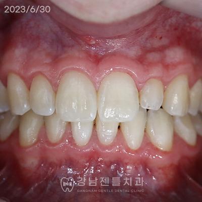 Gentle Zirconia Crown