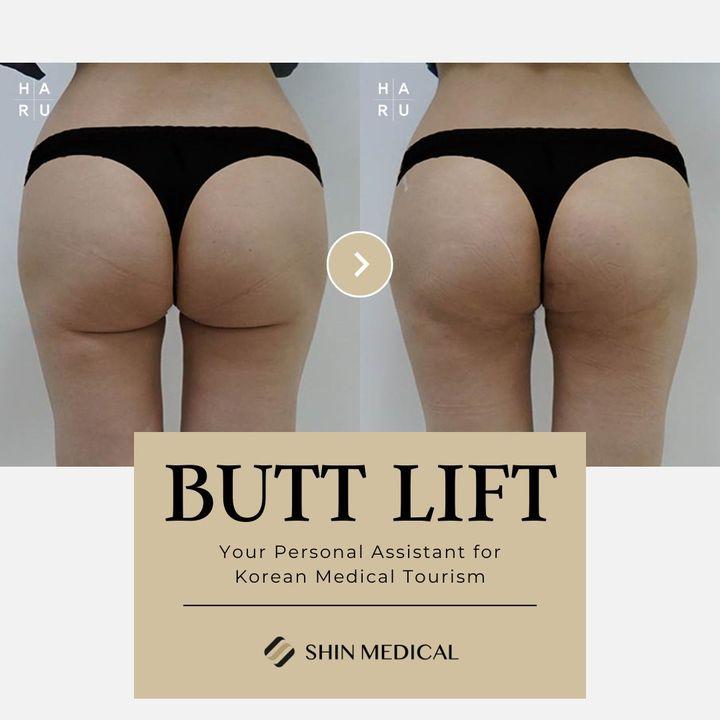 Sagging Buttocks After Weight Loss: Butt Thread Lift Solutions in Korea for Firm and Lifted Curves