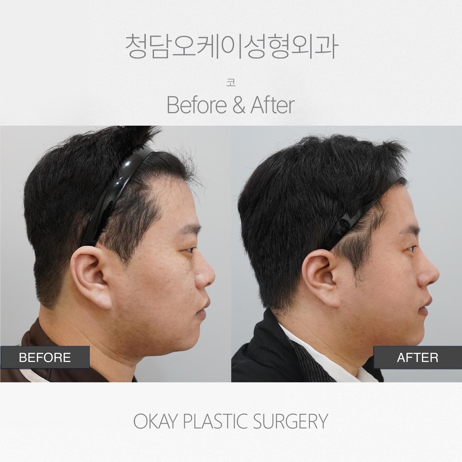 Okay Plastic Surgery Clinic before and after image