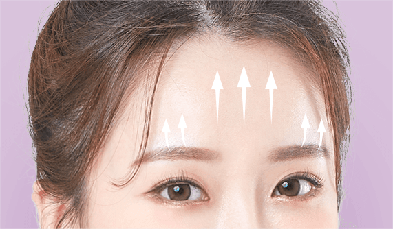Forehead Lift