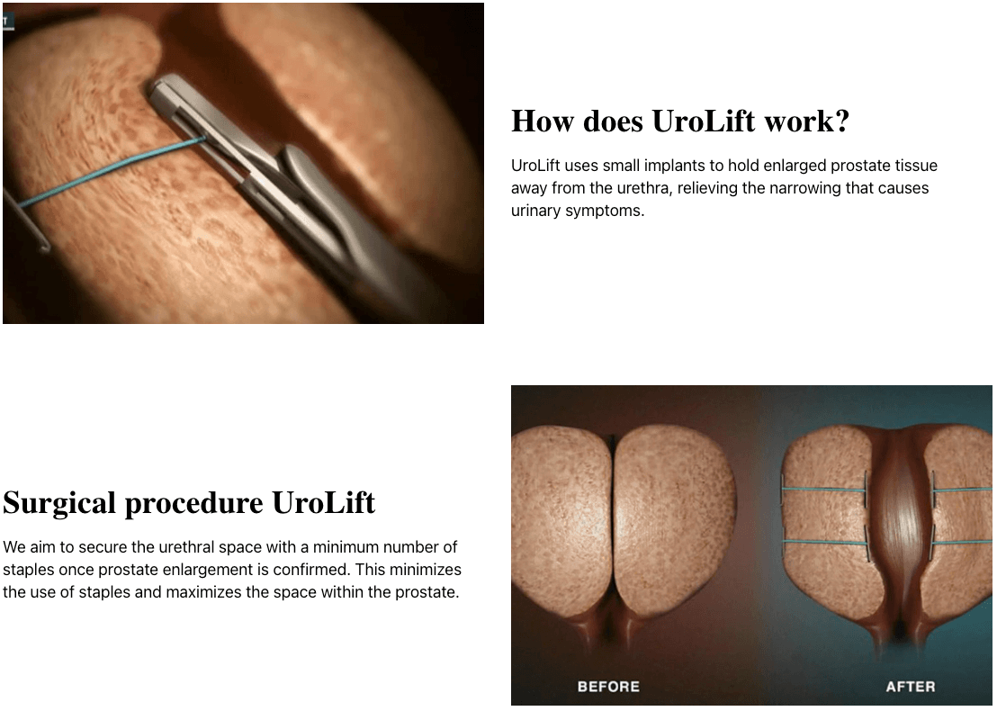 UroLift