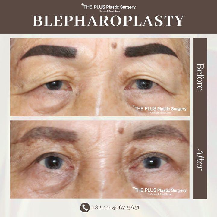 Rejuvenate your gaze with our blepharoplasty procedure. The before and after photos illustrate how we can refresh and brighten your eyes, offering a more youthful and rested appearance. Begin your journey to a revitalized look. #BrighterEyes #YouthfulGlow â–ş