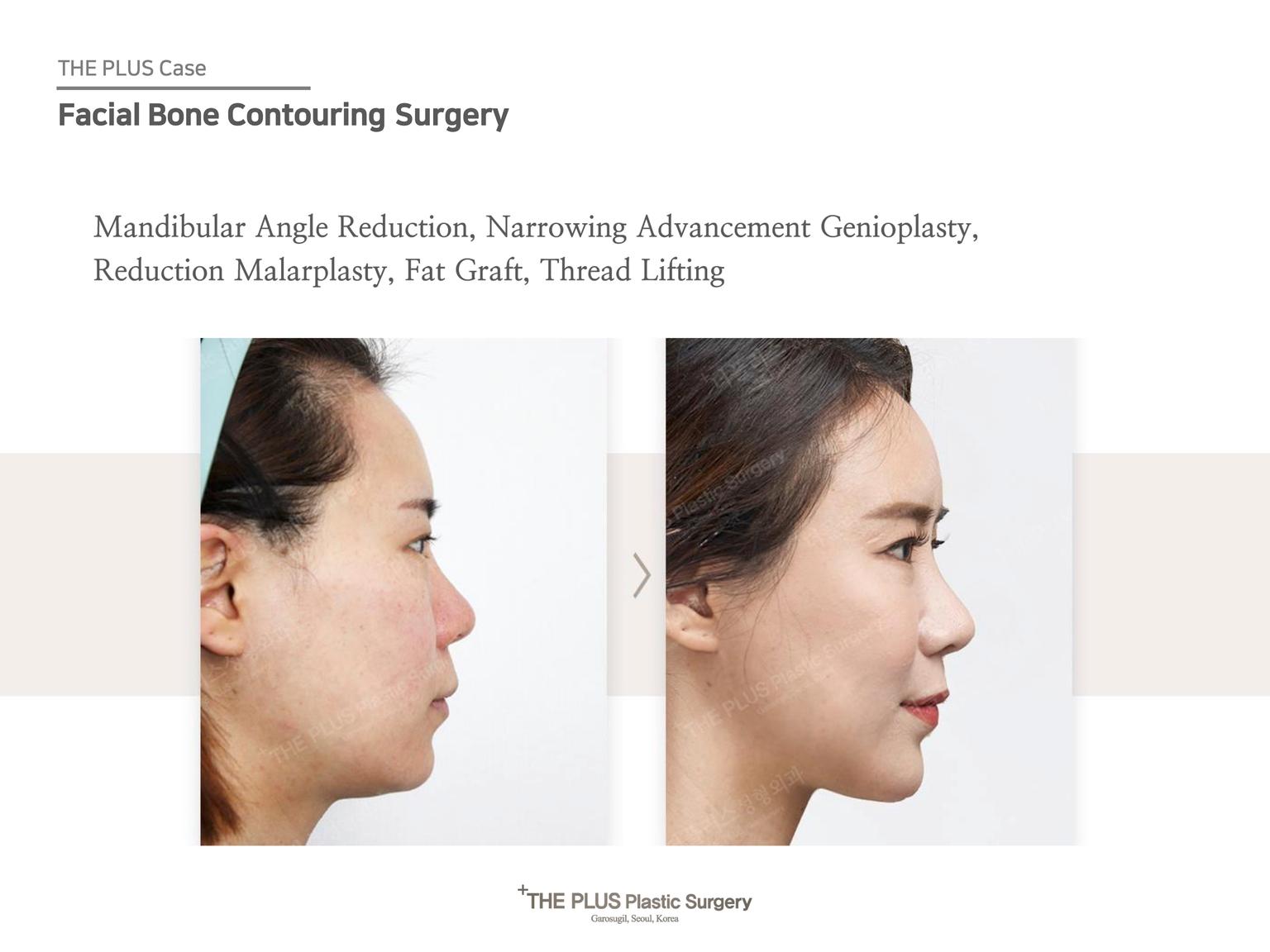 Mandibular Angle Reduction & Narrowing Advancement Genioplasty & Reduction Malarplasty & Fat Graft & Thread