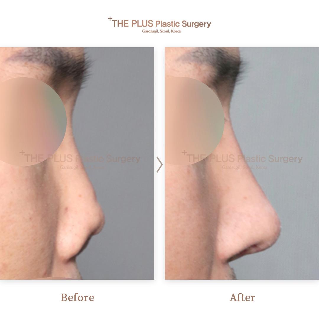 6th Revision Rhinoplasty & Nose Tip & Columella Reinforcement