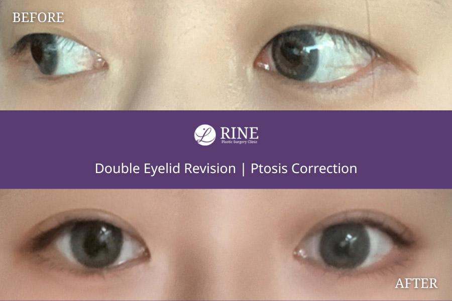 Double Eyelid revision ptosis correction