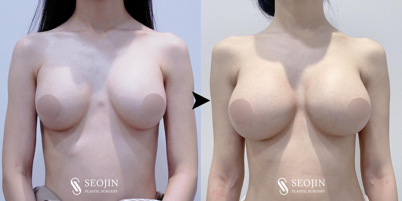 Seojin Plastic Surgery Clinic before and after image