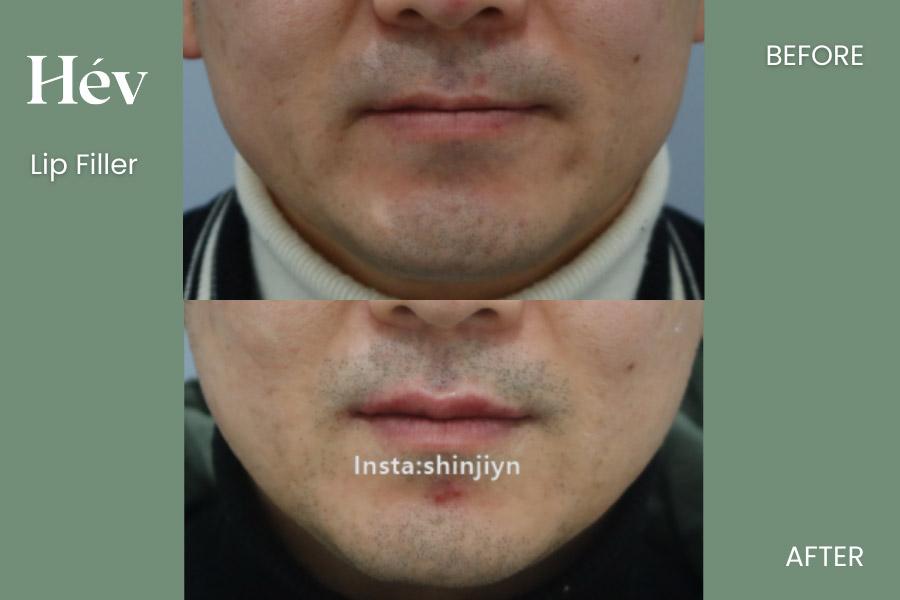 Lip Filler