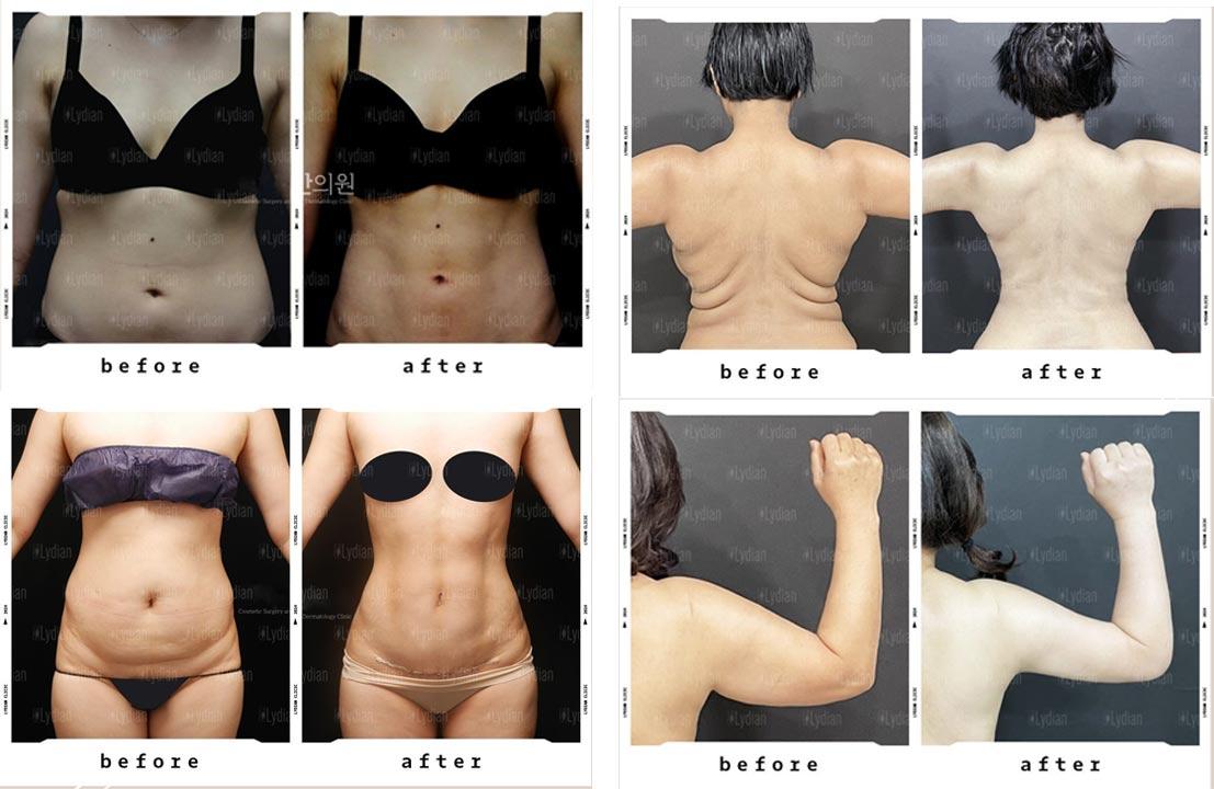 Before and After Full Body Liposuction