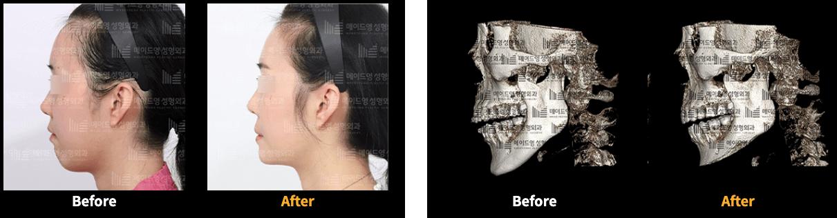 Made Young Plastic Surgery before and after image