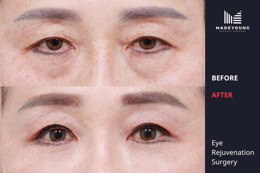 Made Young Plastic Surgery before and after image