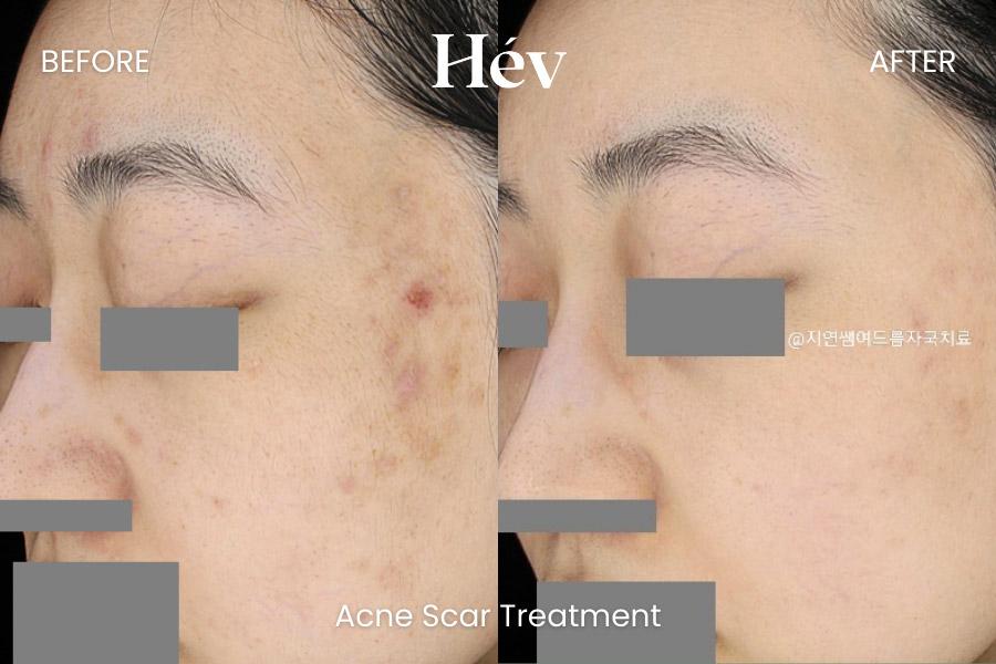 Acne Scar Treatment