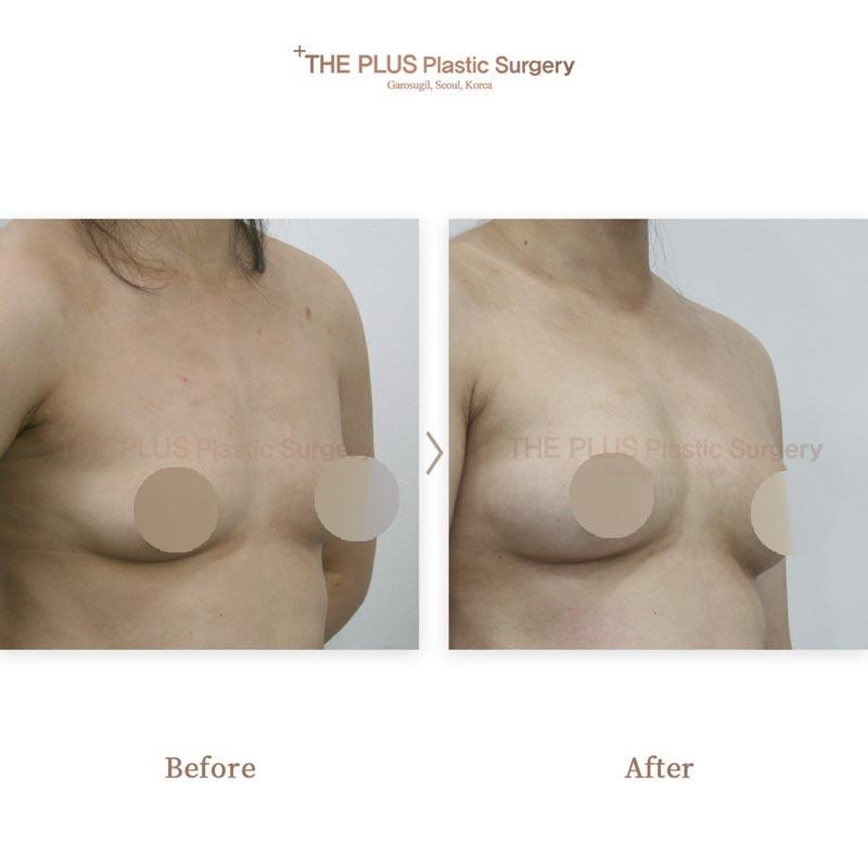 Breast augmentation with autologous fat grafting