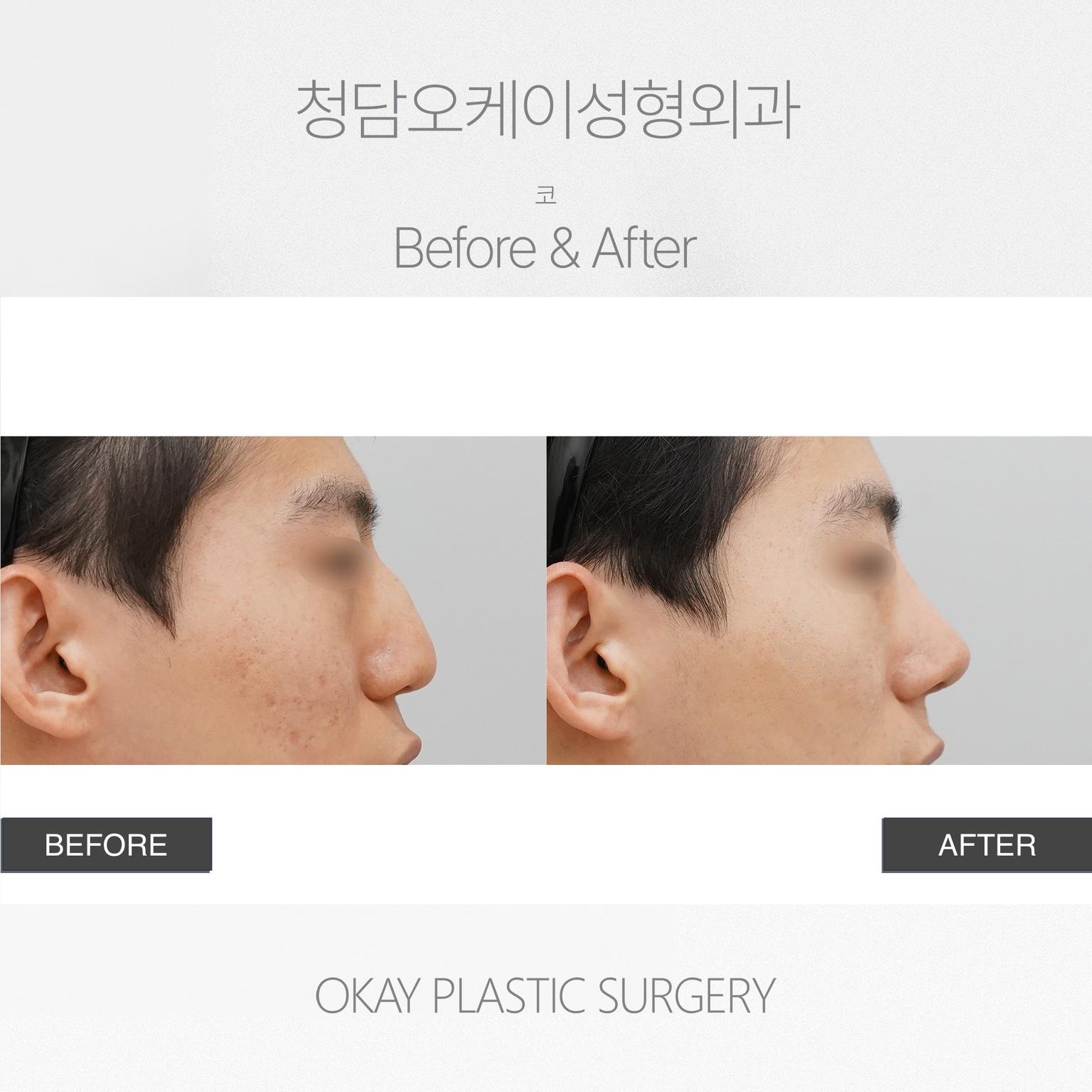 Okay Plastic Surgery Clinic before and after image