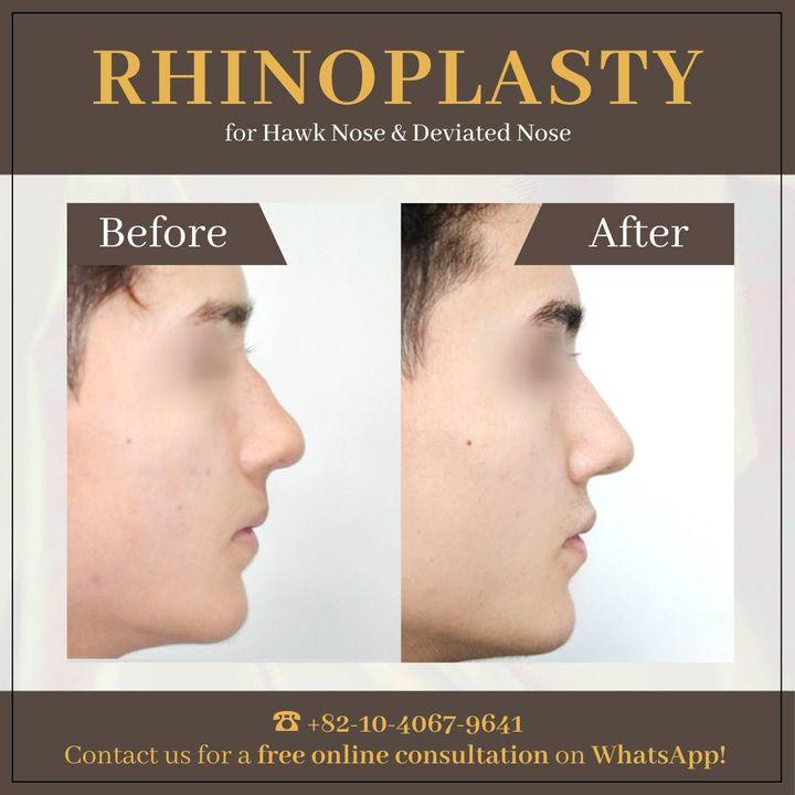 Verändern Sie Ihr Profil mit einer Rhinoplastik bei ThePlus. Der Weg unseres Patienten von einer Hakennase und schiefen Nase zu einem verfeinerten Erscheinungsbild zeigt unser Engagement für Exzellenz.