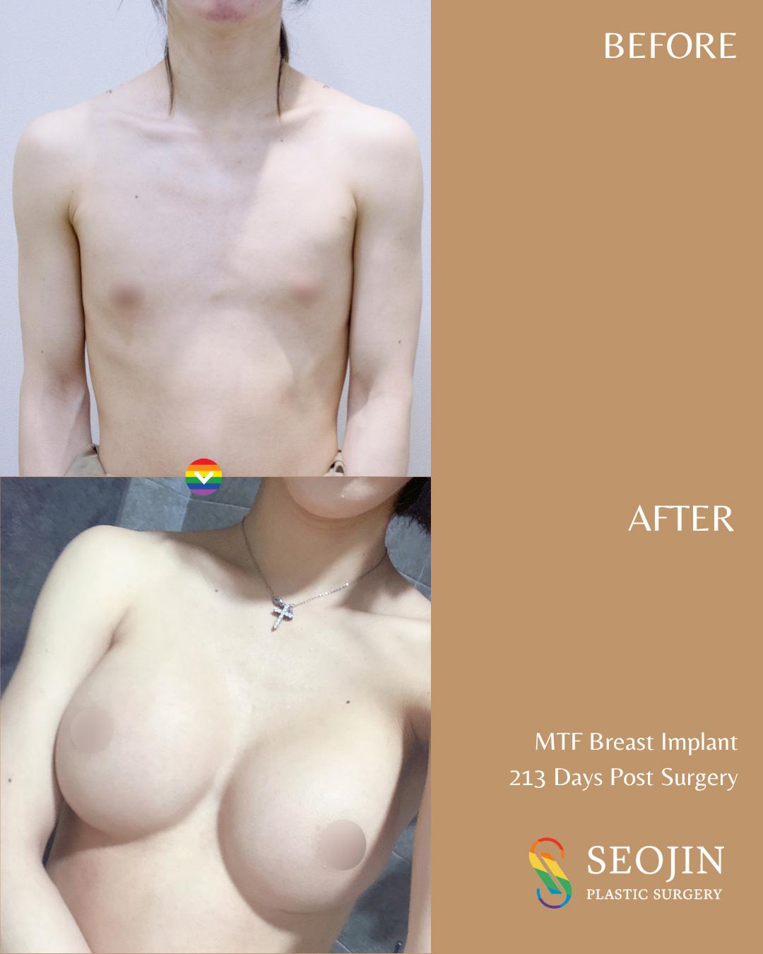 MTF Surgery, Transgender Breast Implants, Top Surgery