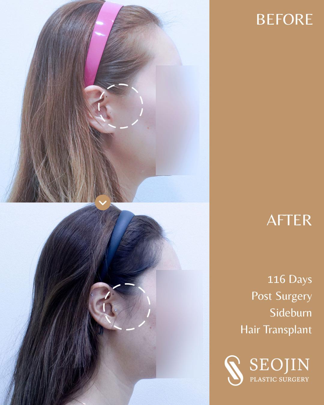 Sideburn Transplant