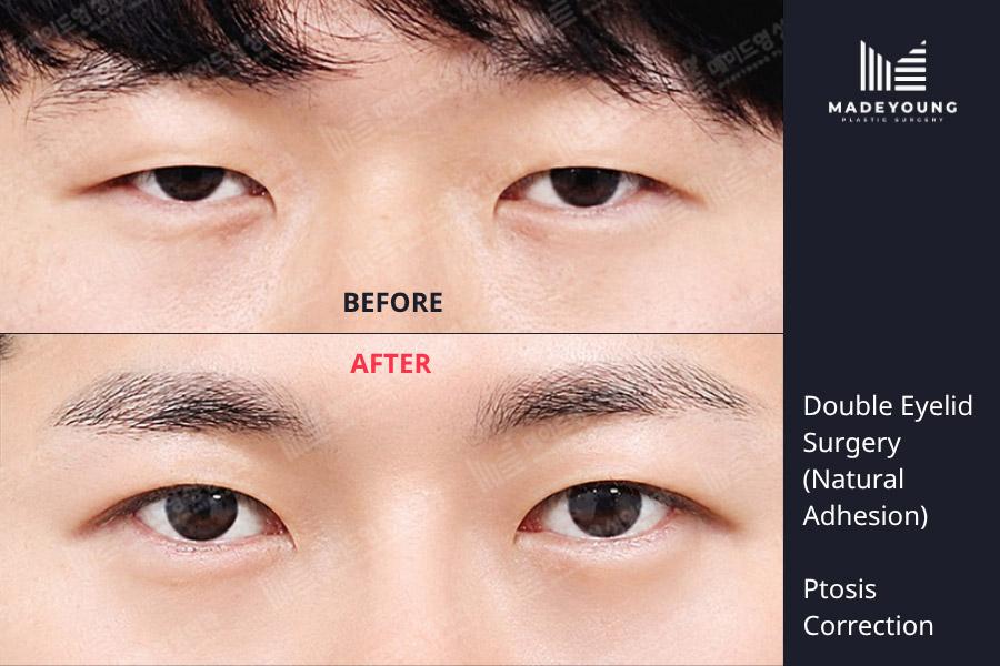 Eyelid surgery natural adhesion ptosis correction