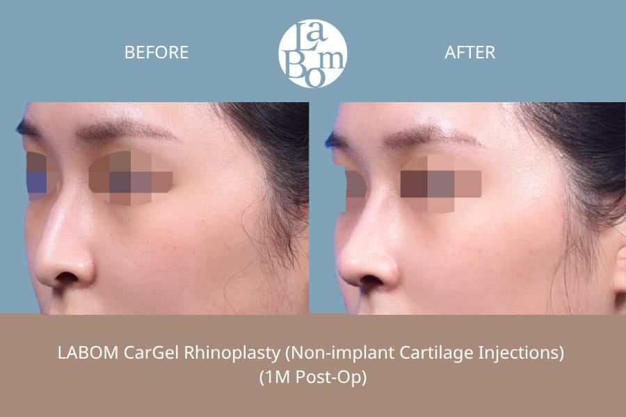 LABOM Plastic Surgery before and after image