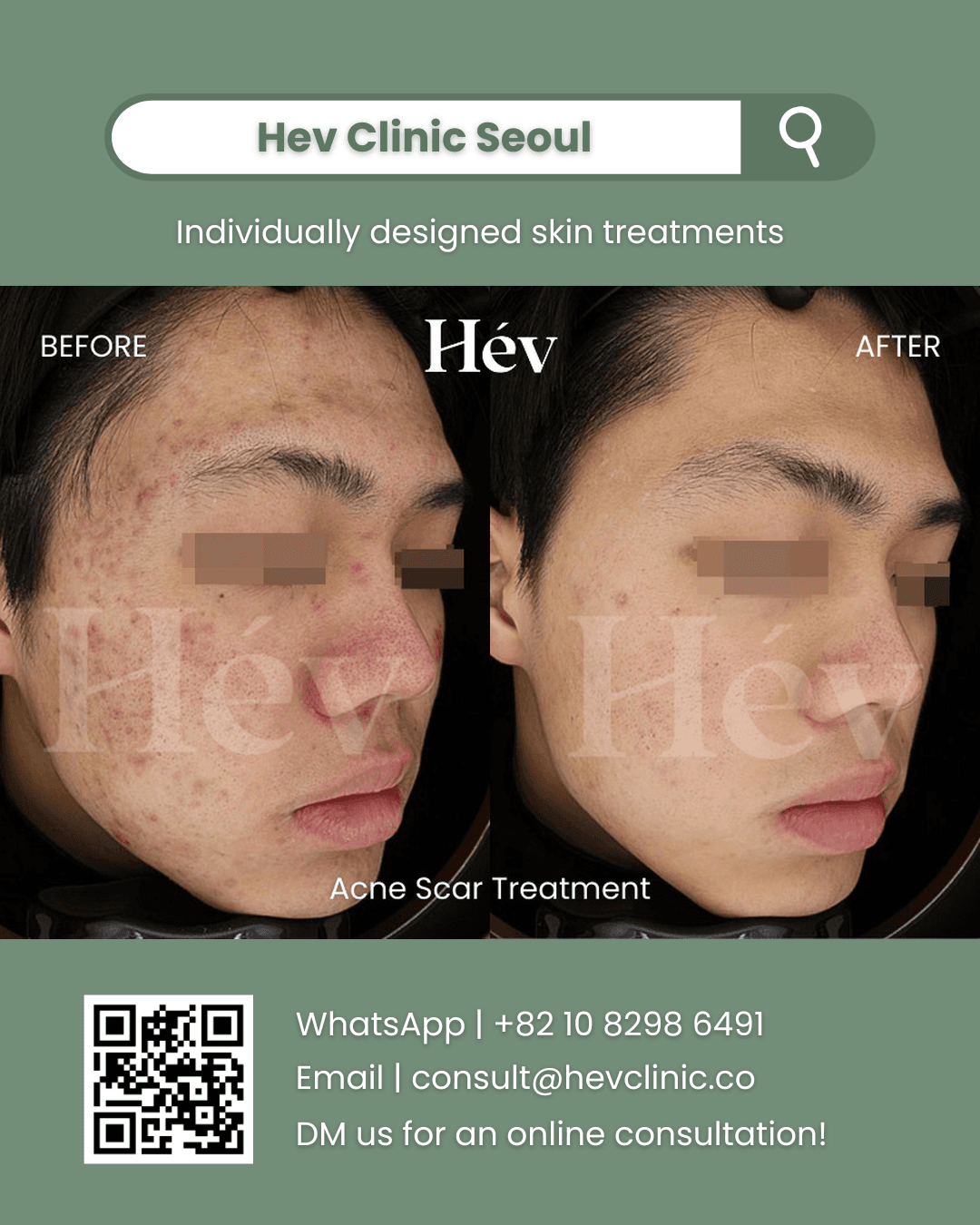 Acne Scar Treatment, Acne Treatment