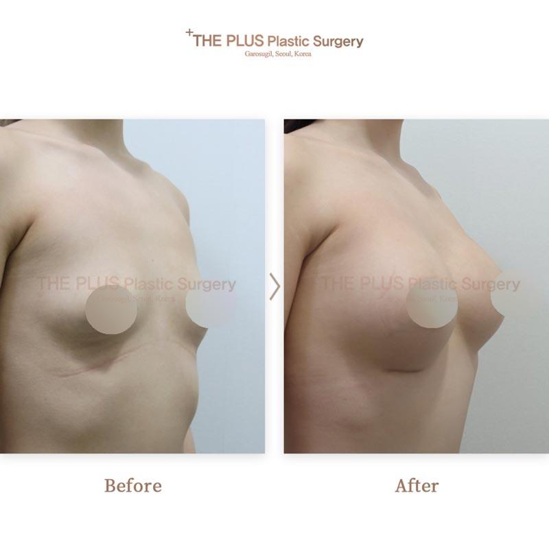 Breast Implant