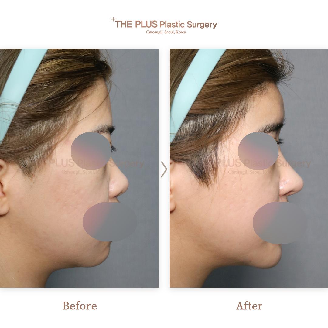 Chin Implant & Face Fat Grafting
