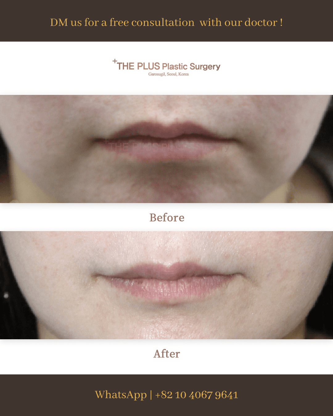 Mundwinkel-Lift mit Botox